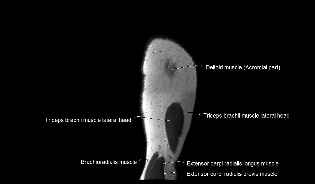 Upper arm (humerus ) saittal cross sectional anatomy 3T image 1.webp